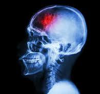 CT Scan